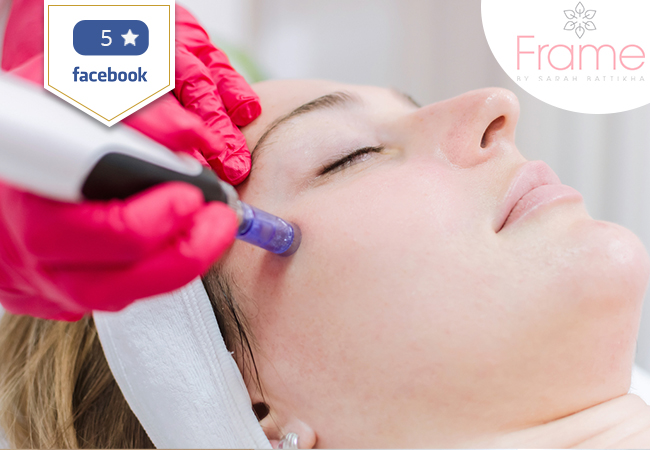 "Microneedling really works!" -VOGUE

Microneedling Facial at Frame (near Manor): Rated 5 Stars on Facebook

Microneedling - the latest trend in non-invasive anti-aging facials - uses micro needles to stimulate collagen production & rejuvenate skin
 Photo
