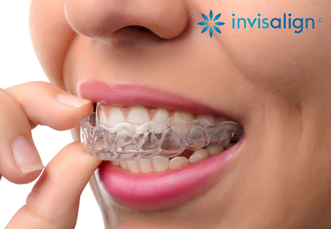 For Adults & Kids
​Orthodontic Check-up plus 10% off Full Orthodontic Treatment (Invisalign® or Braces) at SmileandCare Eaux-VivesWith today's voucher you'll already save CHF 91 on the orthodontic check-up, plus another CHF 500-1500 potential saving if you decide to get the full orthodontic treatment (incl Invisalign)
 Photo