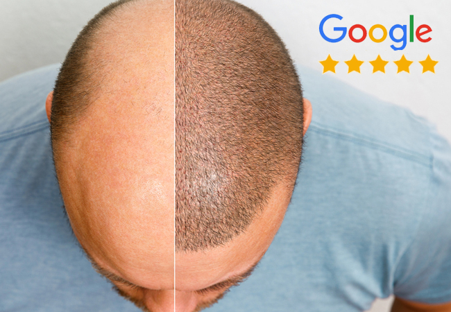 5* on Google
CHF 1'000 Off Hair Transplant at MORE Clinic (Geneva & Lausanne) With full refund of your voucher if you decide to not do the treatment
 Photo