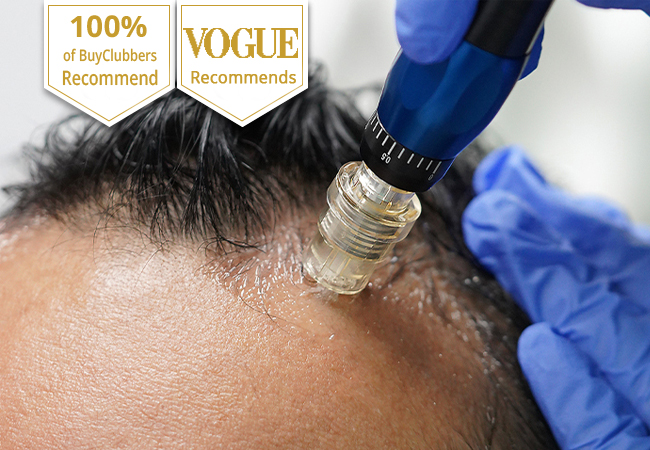 Mesotherapy for Hair Loss at ReGeneva (Airport): 6 Sessions