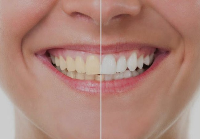 4.8* on Google
Dental Cleaning, Dentist Checkup or Whitening at Dentovive (Eaux-Vives / Nyon)
All treatments - incl cleaning - are done by dentists
 Photo